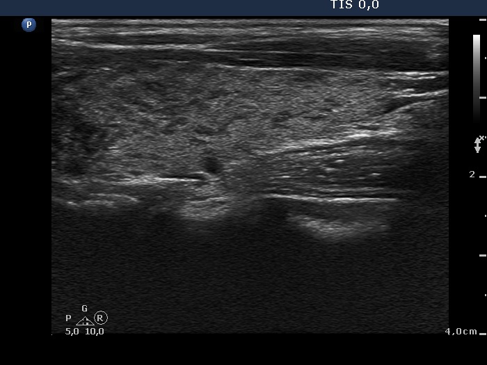 Right lobe, longitudinal scan