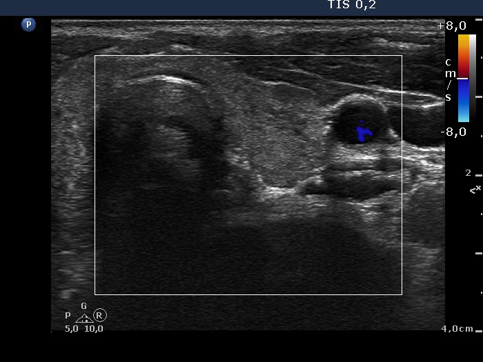 Right lobe, longitudinal scan