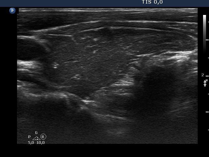 Right lobe, longitudinal scan