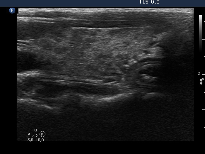 Right lobe, longitudinal scan