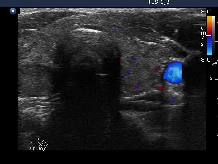 Right lobe, longitudinal scan