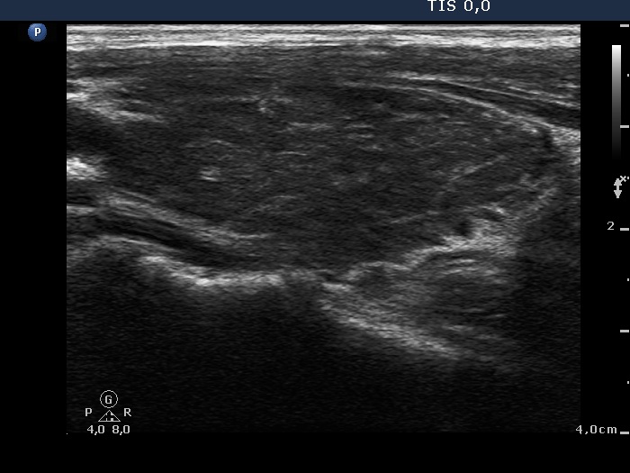 Right lobe, longitudinal scan