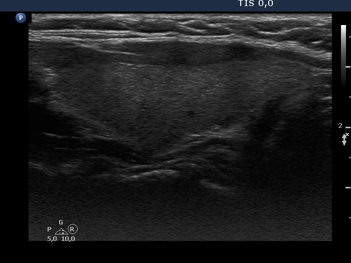 Right lobe, longitudinal scan