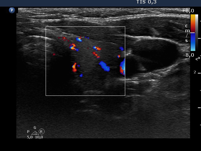 Right lobe, longitudinal scan