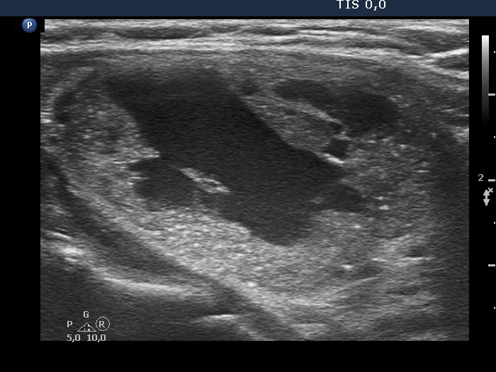 Right lobe, longitudinal scan