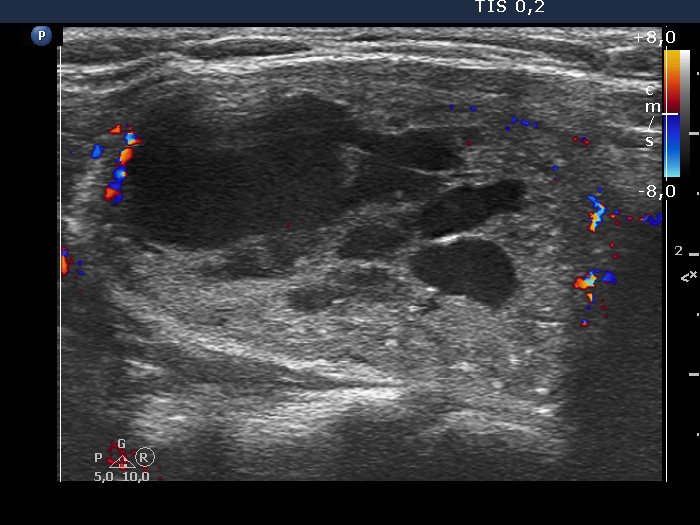 Right lobe, longitudinal scan