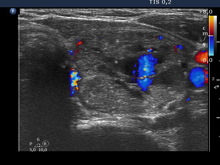 Right lobe, longitudinal scan