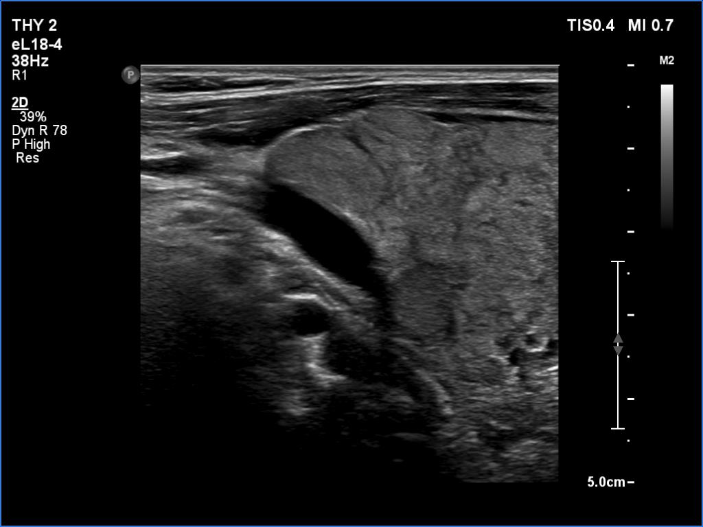 Right lobe, longitudinal scan