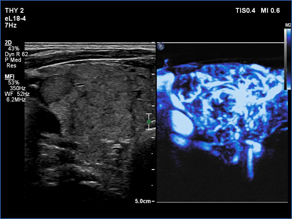 Right lobe, longitudinal scan