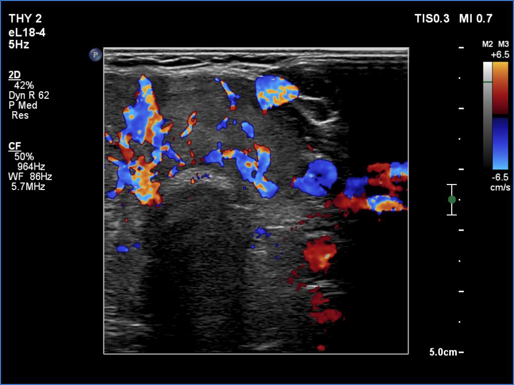 Right lobe, longitudinal scan