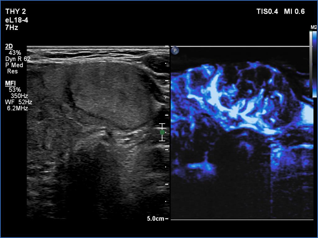 Right lobe, longitudinal scan