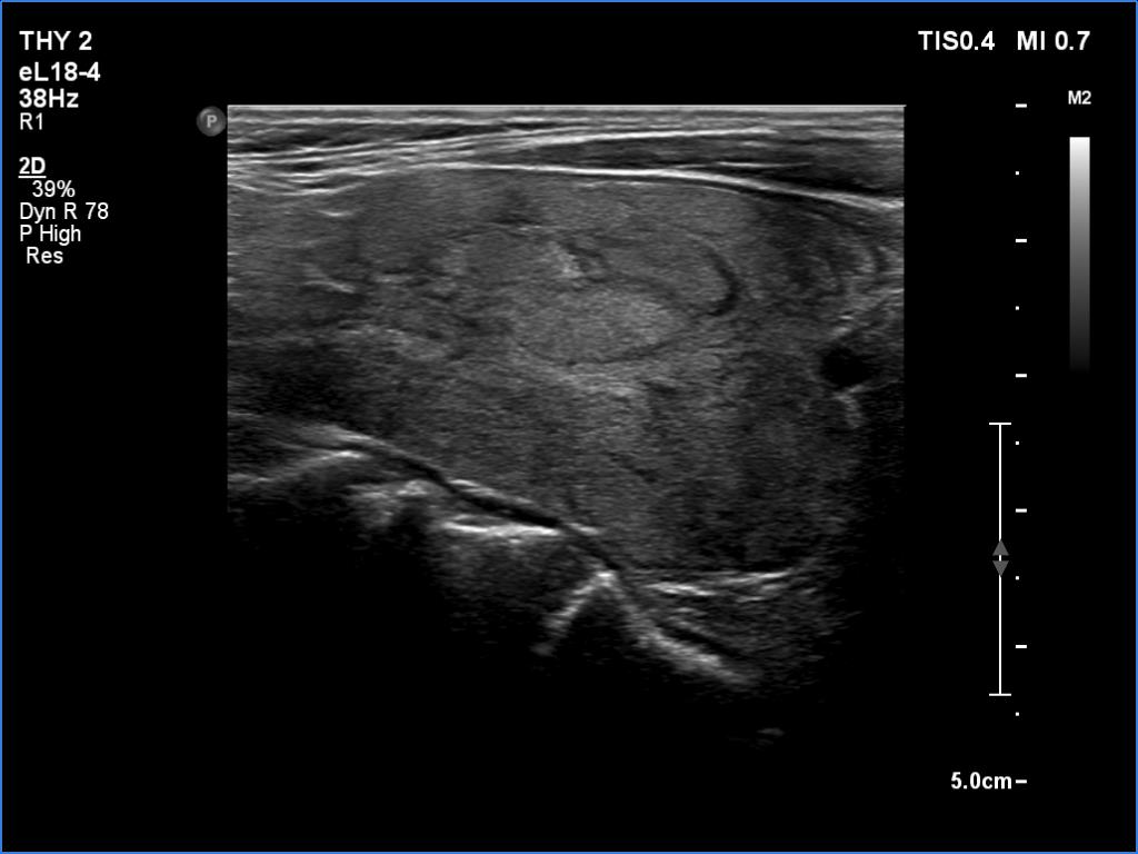 Right lobe, longitudinal scan