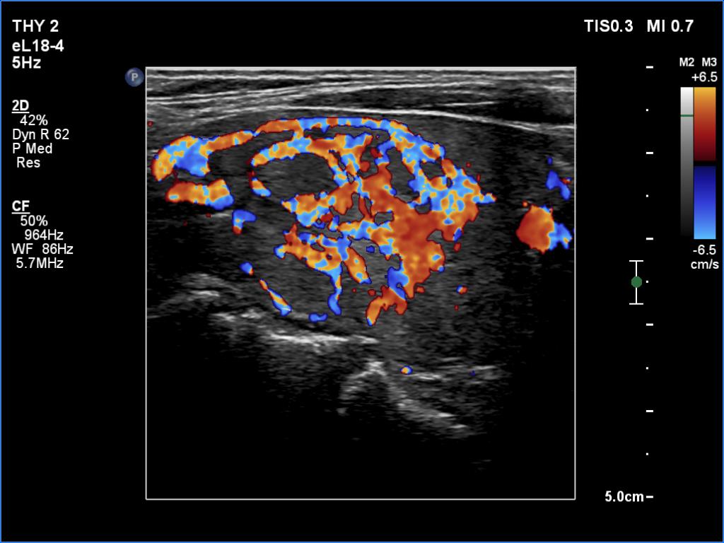 Right lobe, longitudinal scan