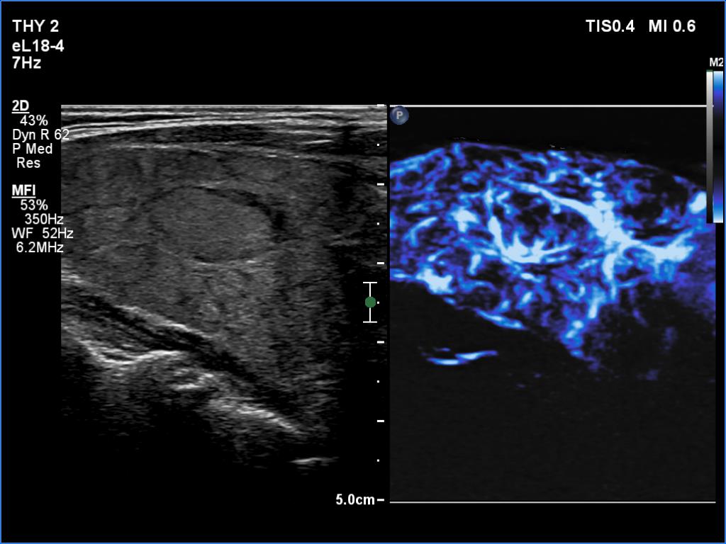 Right lobe, longitudinal scan