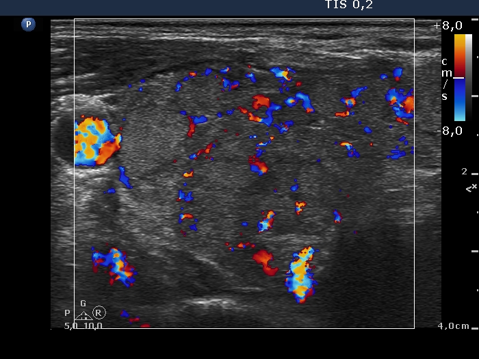 Right lobe, longitudinal scan