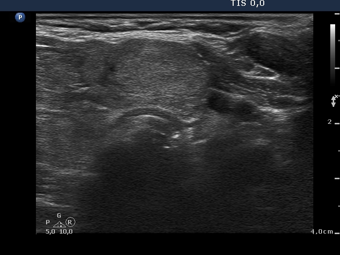 Right lobe, longitudinal scan