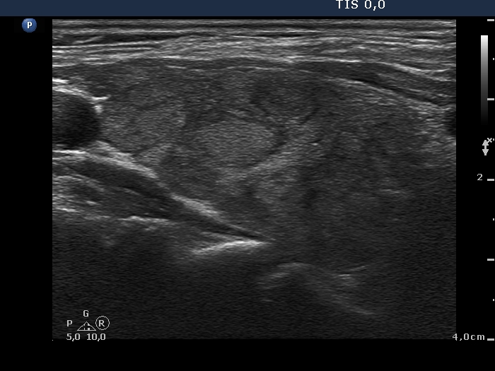 Right lobe, longitudinal scan