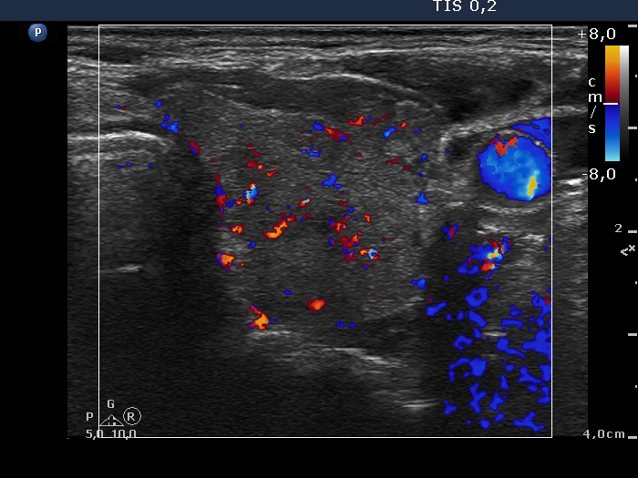 Right lobe, longitudinal scan