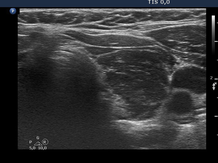 Right lobe, longitudinal scan