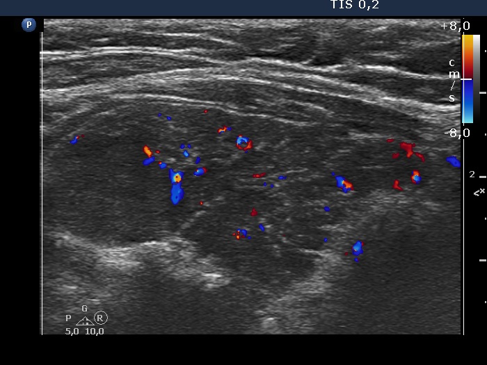 Right lobe, longitudinal scan