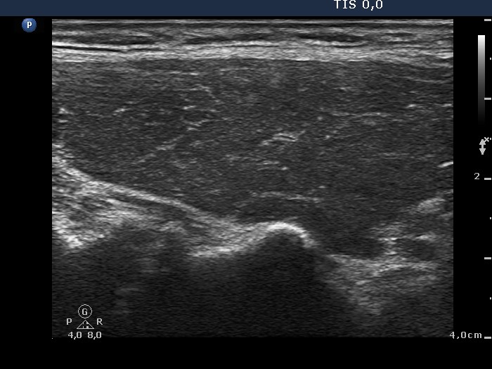 Right lobe, longitudinal scan