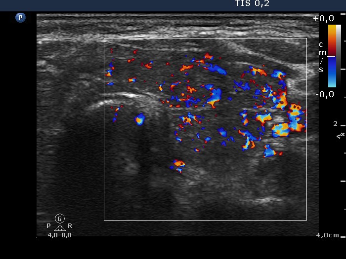 Right lobe, longitudinal scan