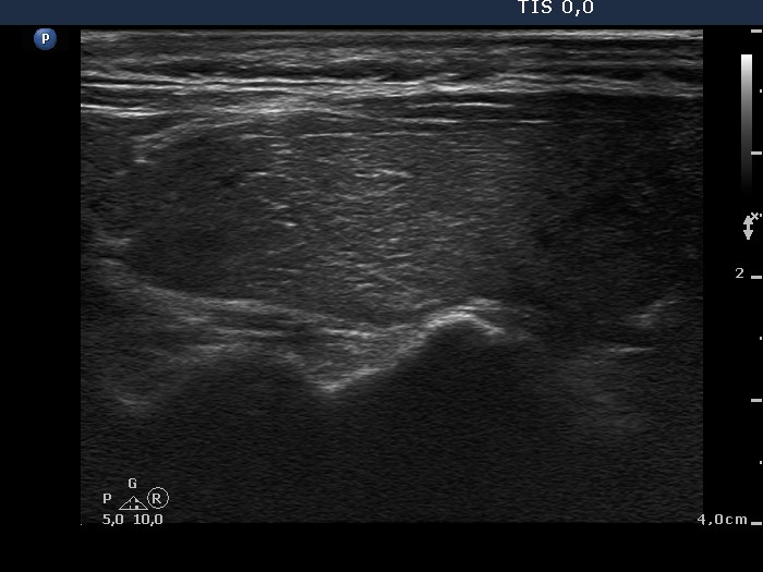 Right lobe, longitudinal scan