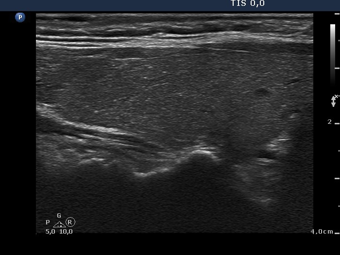Right lobe, longitudinal scan