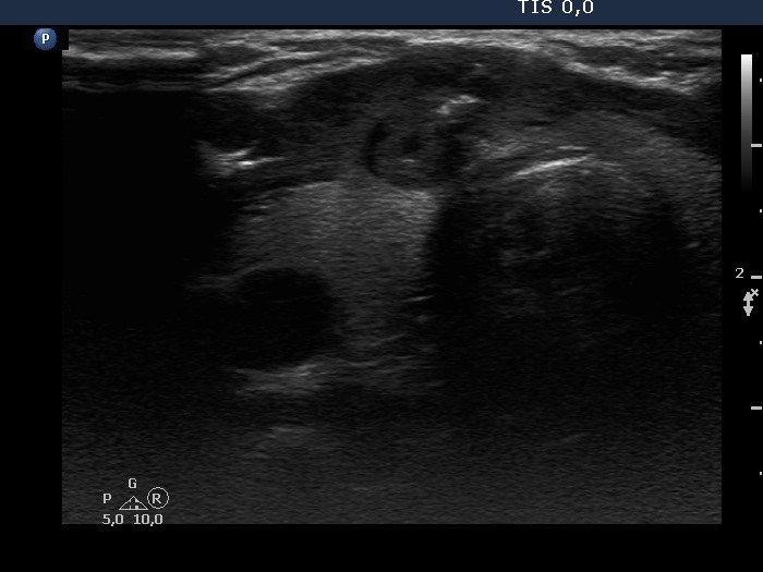 Right lobe, horizontal view