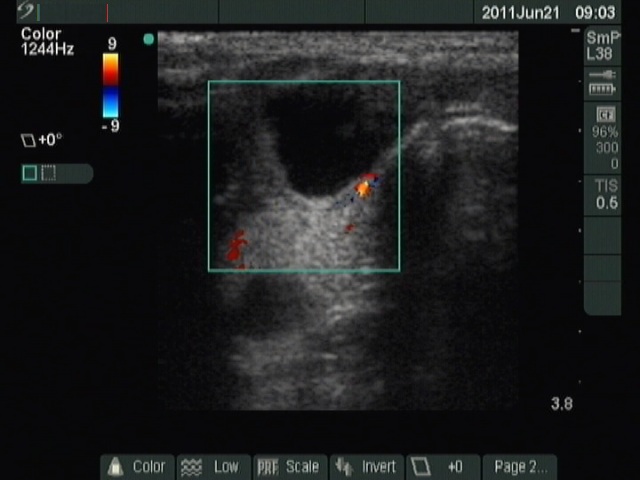 Right lobe, longitudinal scan