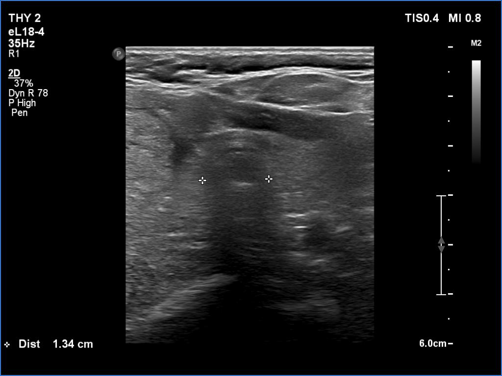 Right lobe, longitudinal scan