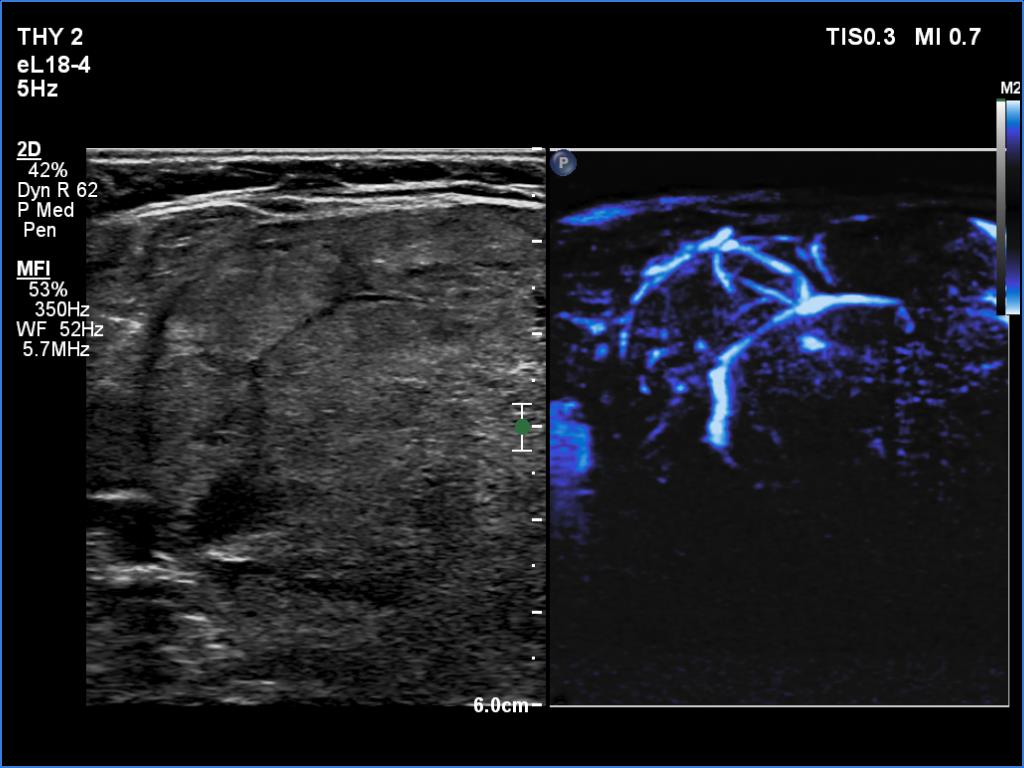 Right lobe, longitudinal scan