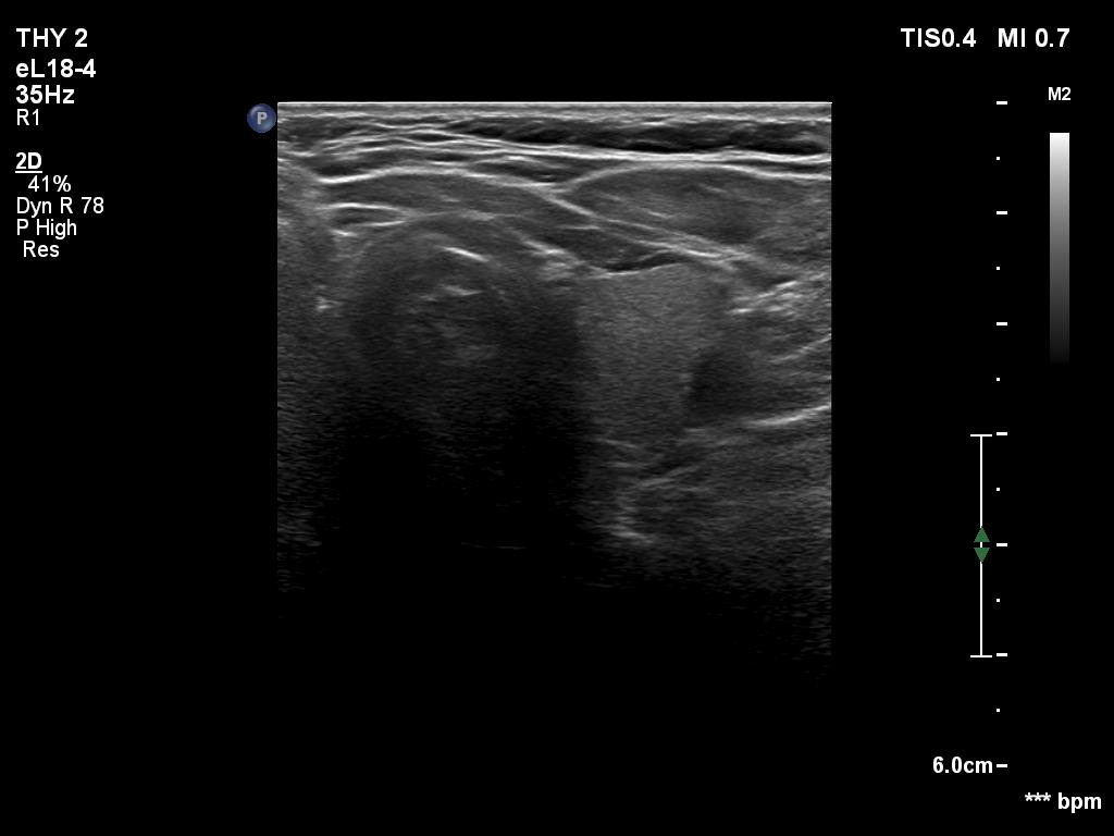 Right lobe, longitudinal scan