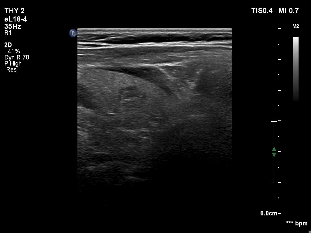 Right lobe, longitudinal scan