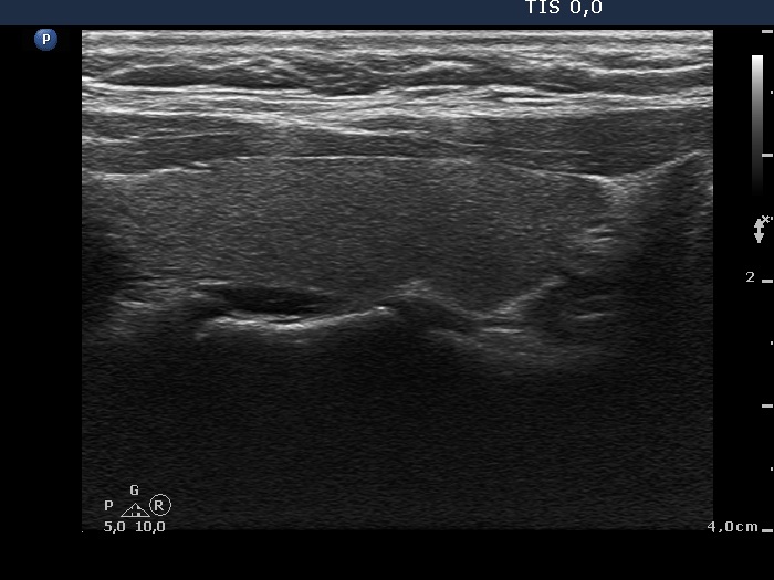 Right lobe, longitudinal scan