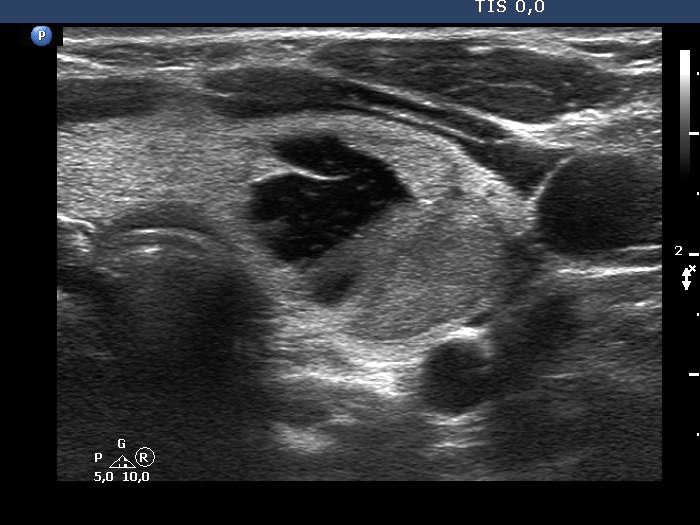Right lobe, longitudinal scan