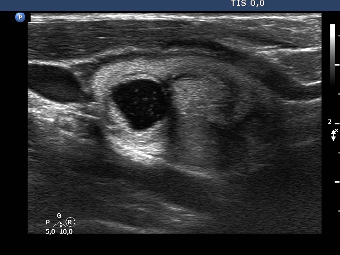 Right lobe, longitudinal scan