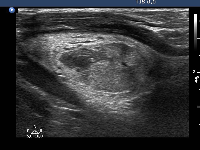 Right lobe, longitudinal scan