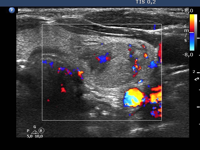 Right lobe, longitudinal scan