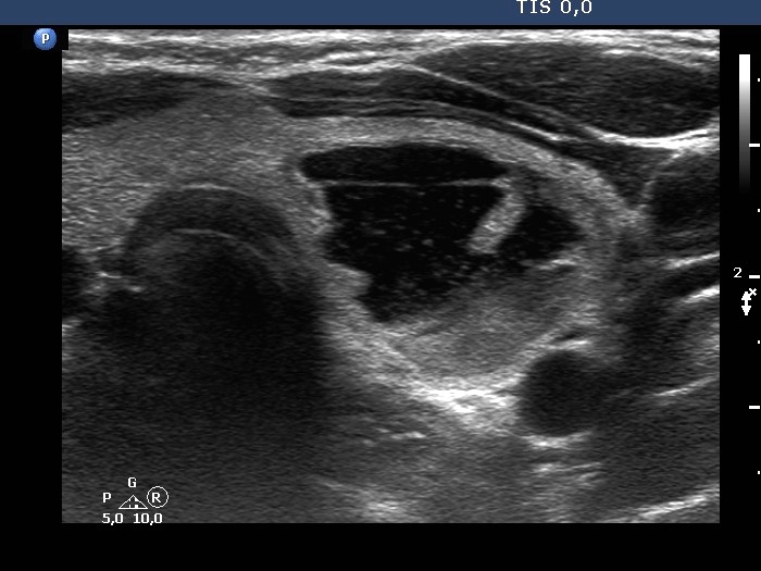 Right lobe, longitudinal scan