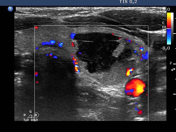 Right lobe, longitudinal scan