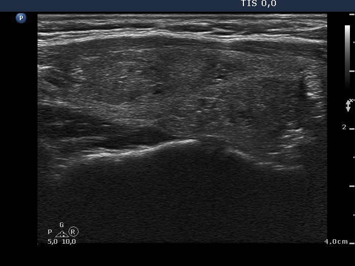 Right lobe, longitudinal scan