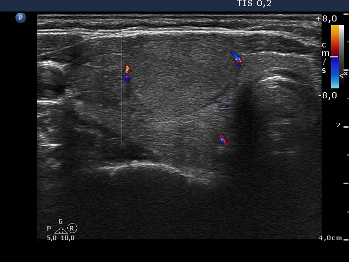 Right lobe, longitudinal scan