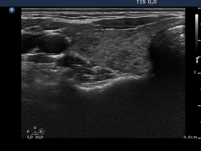 Right lobe, longitudinal scan