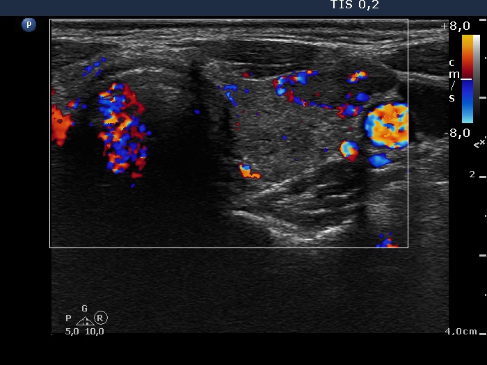 Right lobe, longitudinal scan