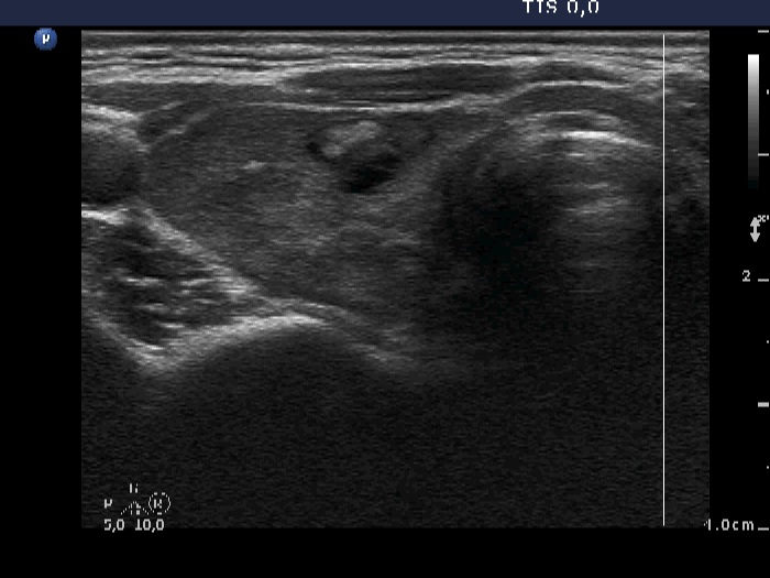 Right lobe, longitudinal scan