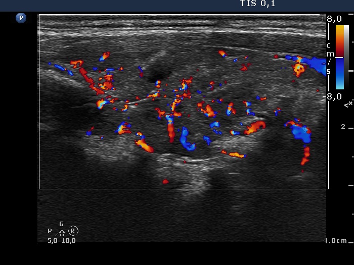 Right lobe, longitudinal scan