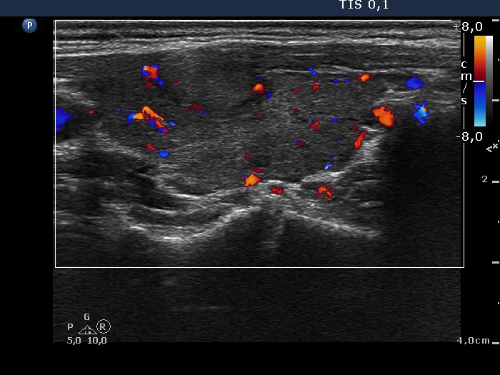 Right lobe, longitudinal scan