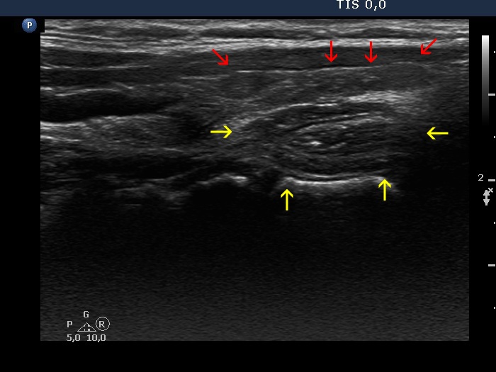 Right lobe, longitudinal scan