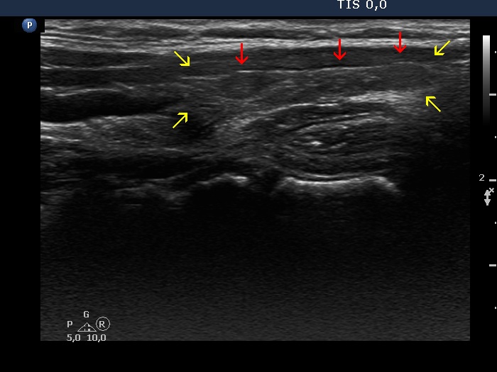 Right lobe, longitudinal scan